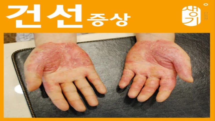  건선피부 따뜻한 날씨에는