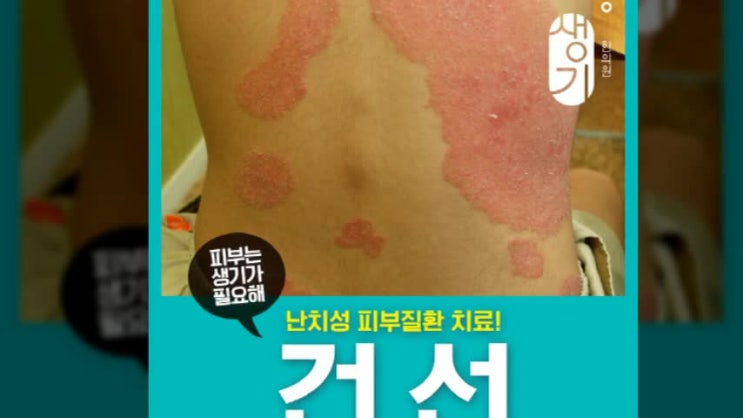  사타구니건선 문제를 직면하기로