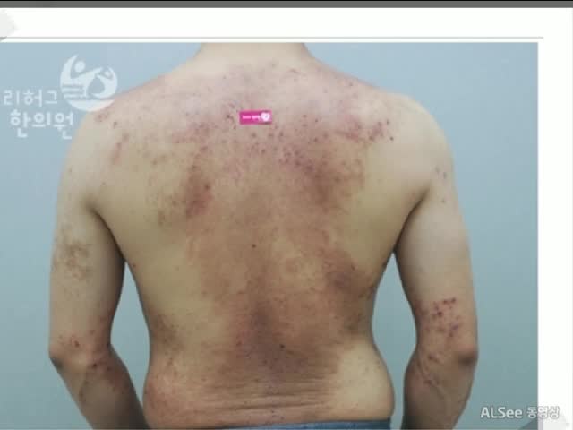  부산아토피 더운 날씨에 심해졌어요..