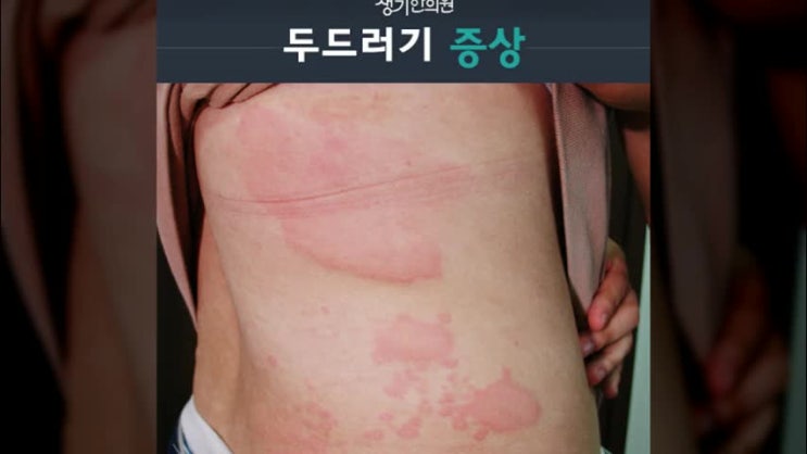  콜린성두드러기 간절히 벗어나고싶어
