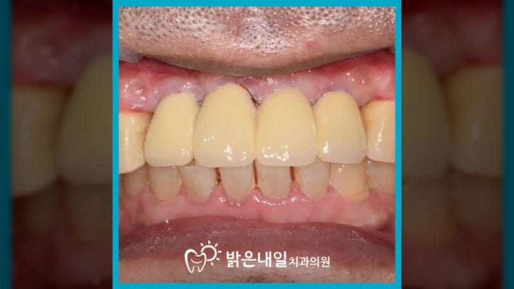  구리임플란트 네비게이션으로 하면