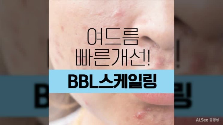 대구여드름피부과 방학을 놓치지말아요