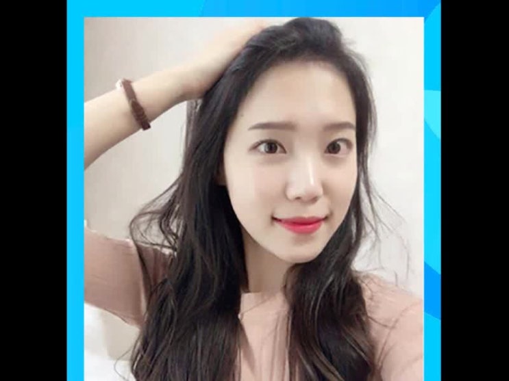  헤어라인교정후기 단정하고 깔끔해진 얼굴윤곽