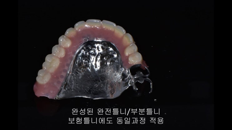  만 65세 이상 노인틀니/보험틀니 제작/비용
