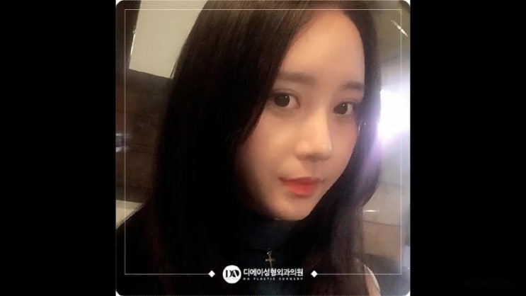  코수술후기 내가 생각했던 변화를 위해