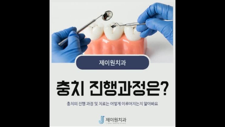  순천충치치료 어떻게 이루어질까?