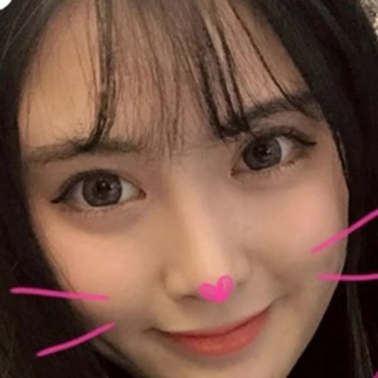  뒷트임후기 너무 자연스러워서 친구들이 수술 안한줄 알았데요!!