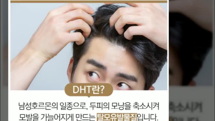  남자정수리탈모원인 유전 말고는 ?