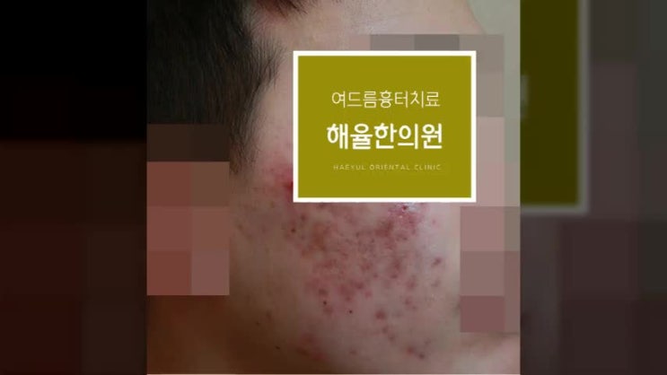  부산여드름흉터치료 이렇게해봐요