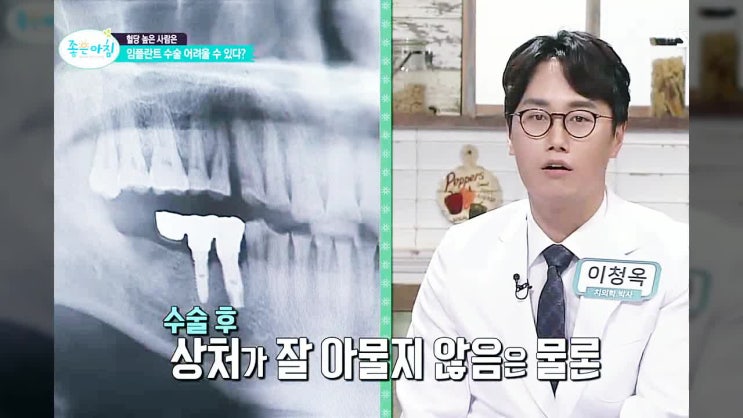  부평 인근 치과추천, 임플란트(implant) 오래 쓰는 방법