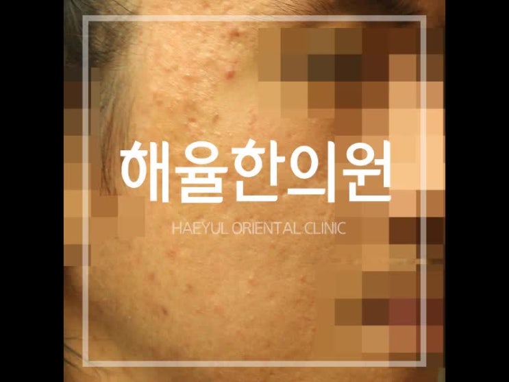  창원여드름흉터 새살이 차올라