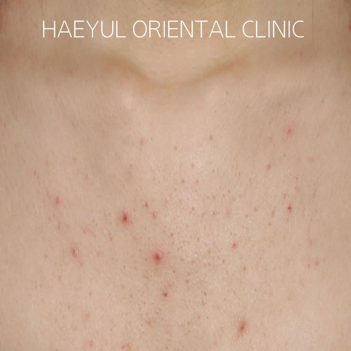  울산가슴여드름 제거시술 HOW TO