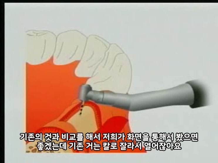  [진주치과추천/진주임플란트전문] 레이저 임플란트 시술, 정형주 대표원장 - 진주 우리들치과병원