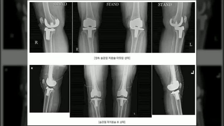  무릎인공관절수술 삶의 만족도를 높여요!
