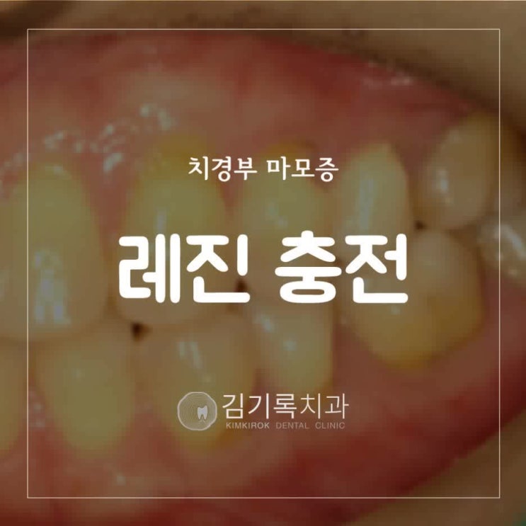 영통충치치료잘하는치과 치경부마모증 치아 패임 잇몸 패임 이시림 증상 레진 충전 치료
