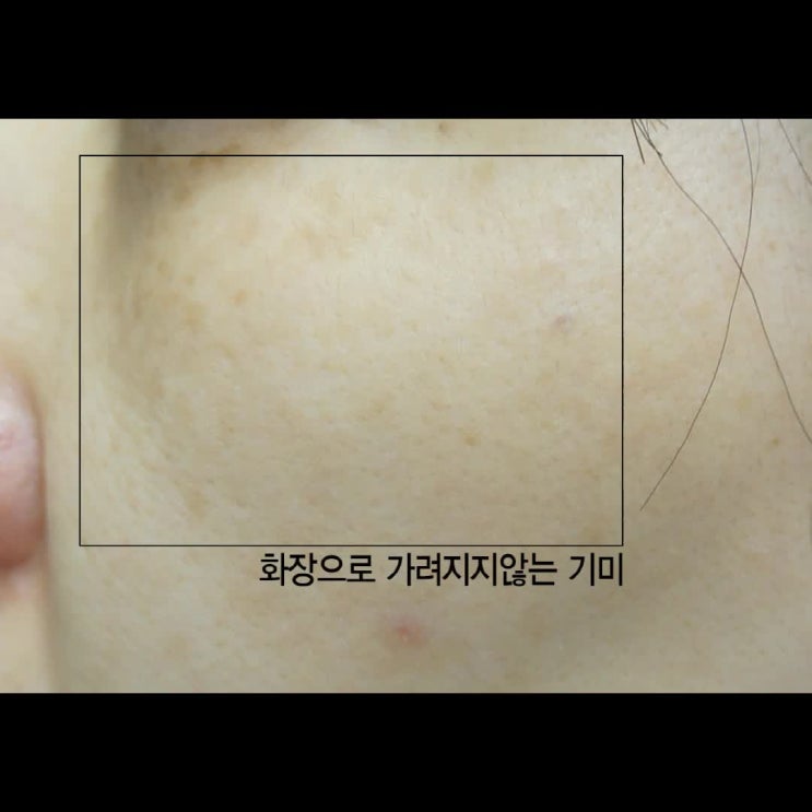  양재피부과 여름동안 탄 피부를!