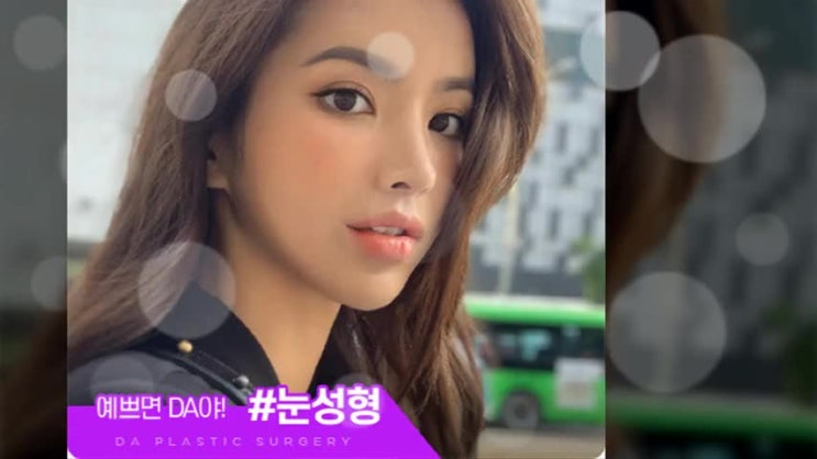  비절개눈매교정 자연스러운 느낌으로
