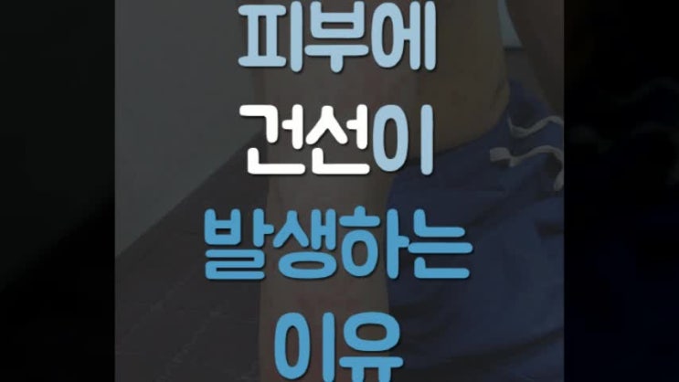  건선한방치료 극심해지는 만성증상 이어진다면
