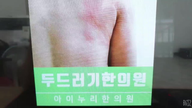  대전 피부습진 원인을 파악하는 치료를 통해서