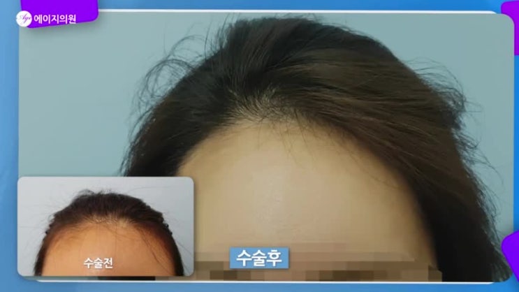  부산 헤어라인교정 부럽다 정말 #예쁨주의