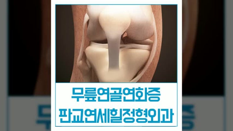  무릎연골연화증 악화되기 전 치료받으세요