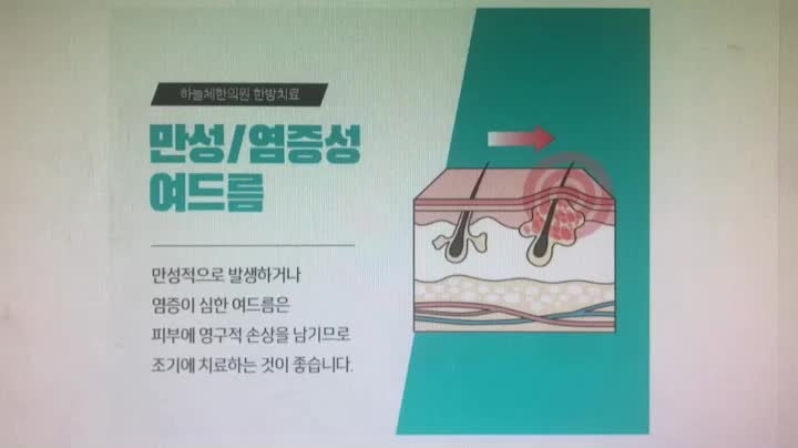  일산여드름 트러블 악화의 원인