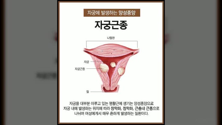  자궁근종증상 신중하게 결정해요
