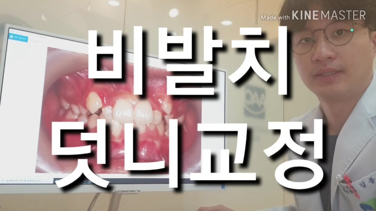  비발치 덧니교정 이제는 필수입니다.