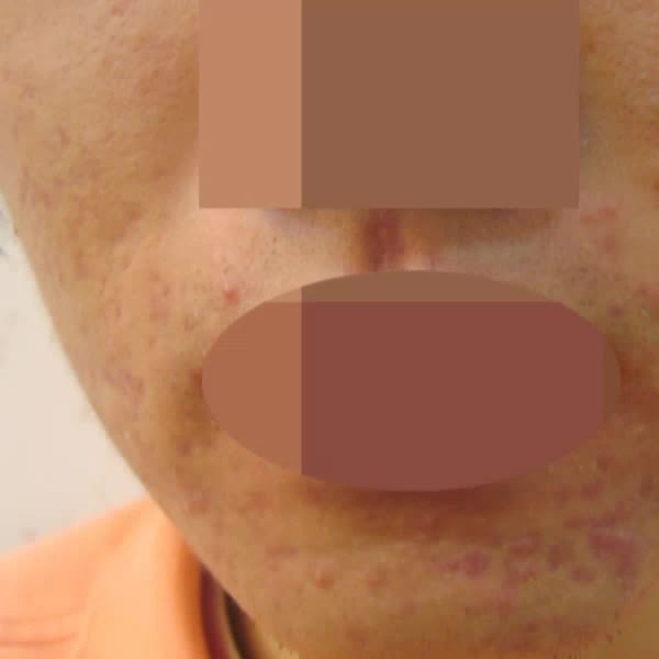  대전여드름흉터 다양한 케이스에도 걱정없이 치료해봐요!