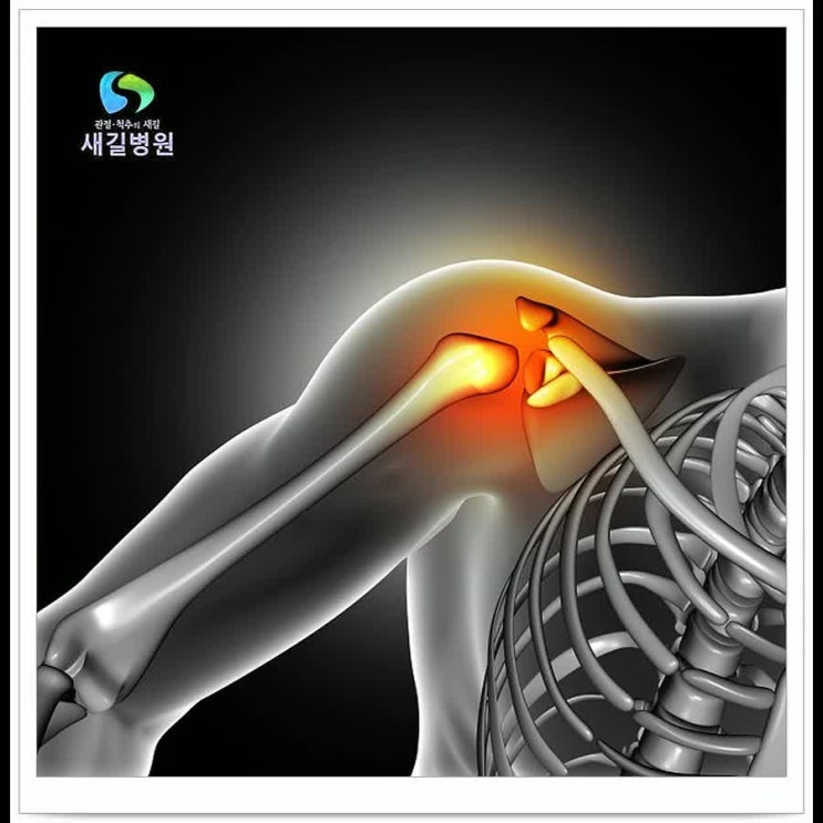  어깨회전근개파열 보전적 치료가 우선시 되어야