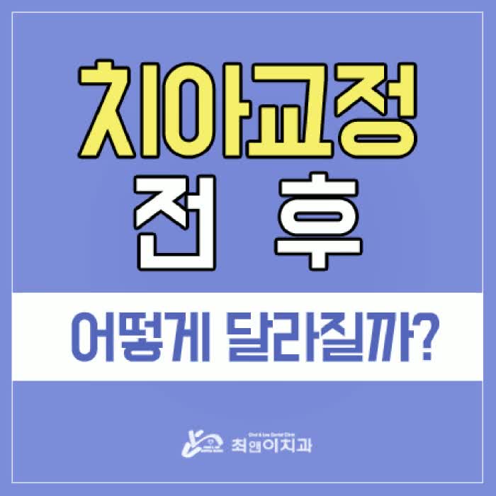  치아교정전후 미소가 한결 편안해 보여