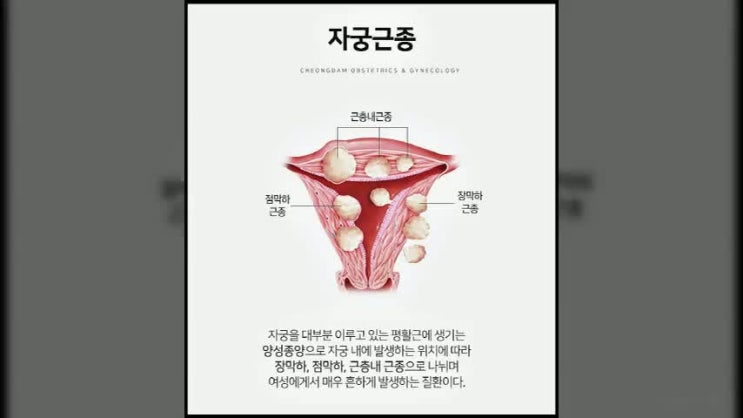  자궁근종수술 꼼꼼한 파악 이뤄져야