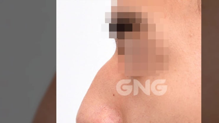  남자코수술비용 구분을위해서