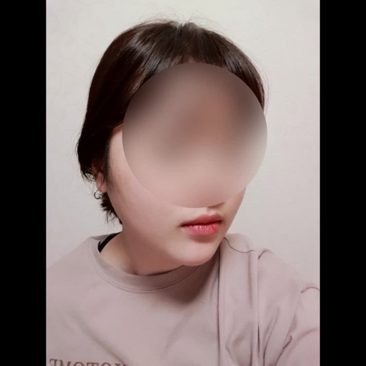  이중턱지방흡입 괜한 카메라 탓만?