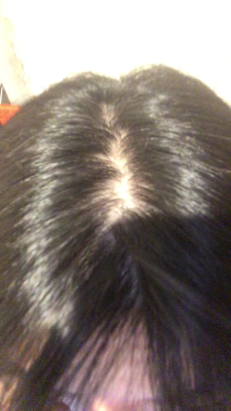  휴지기 탈모 그냥 두기에는 가을 머리빠짐이 심함 (본인피셜 有)