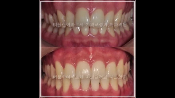  광안동치아교정 부산과개교합 비발치교정 전문의치과
