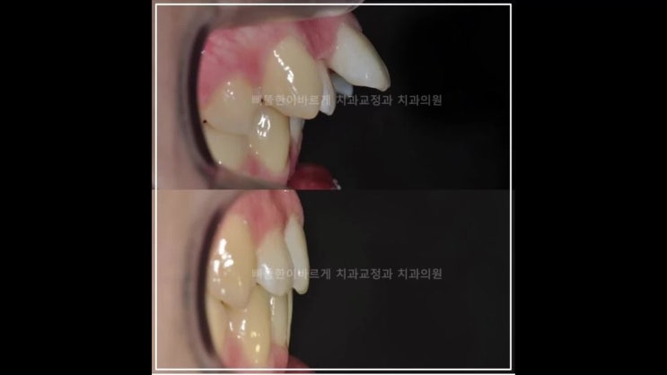 대연동치아교정 부산뻐드렁니 편악발치 교정전문의