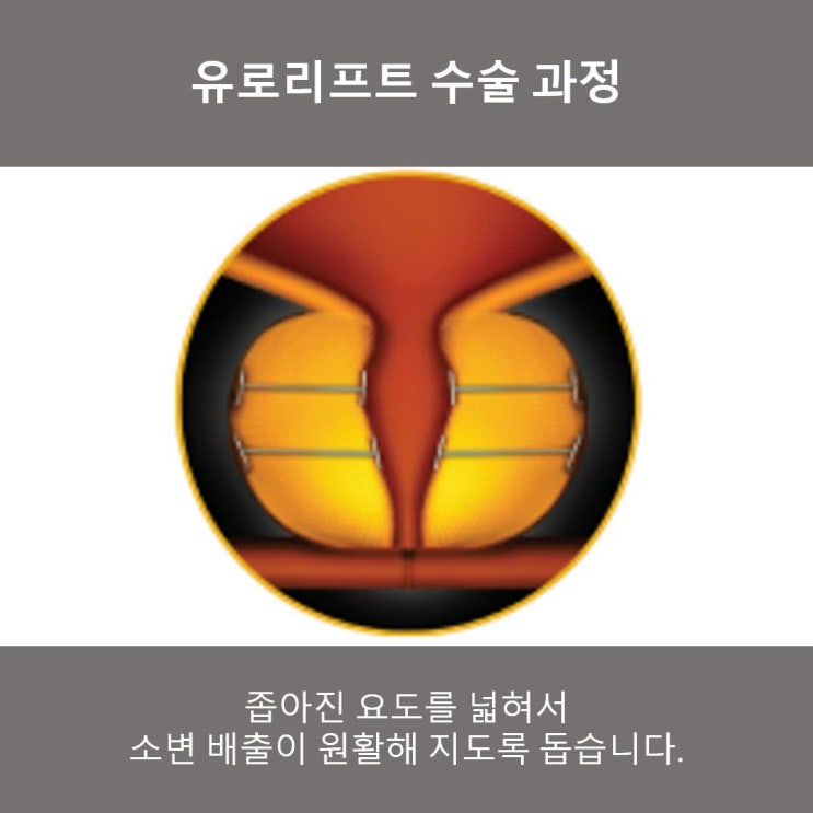  전립선 비대증 유로리프트 수술의 특징