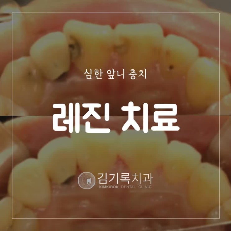 수원앞니치료 앞니 충치가 심해 레진으로 충치치료 했어요!