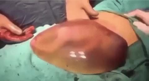  양수 주머니채로 태어난 아기