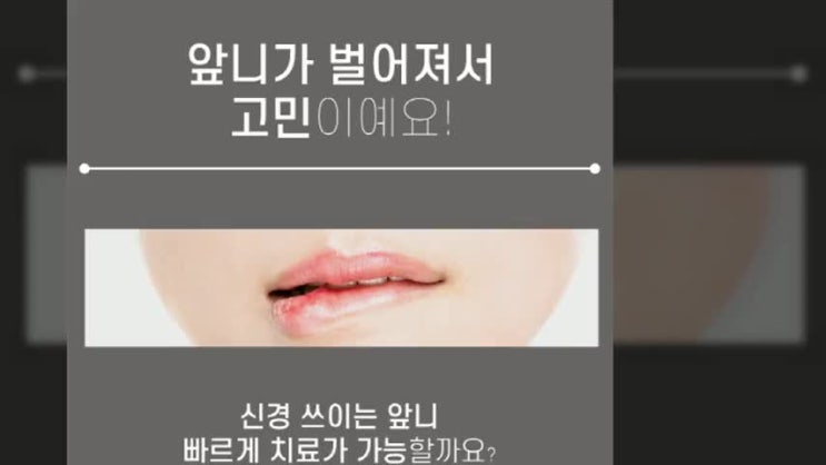  앞니가 벌어졌어요 치아교정은 부담스러운데