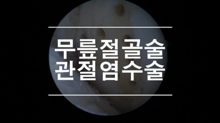  근위경골절골술 퇴행성관절염 으로부터 자기 관절 지키는 방법