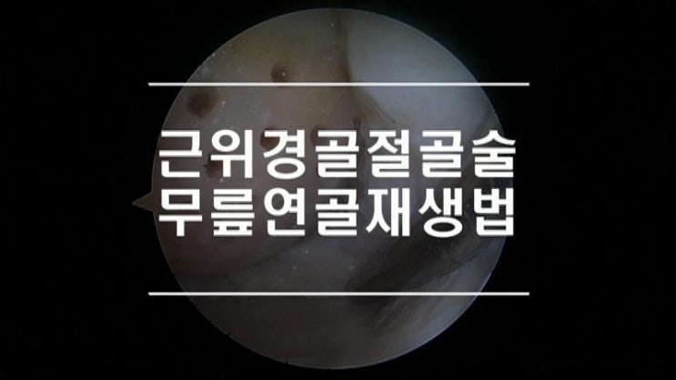  근위경골절골술 이란 무릎절골술 로 무릎연골재생
