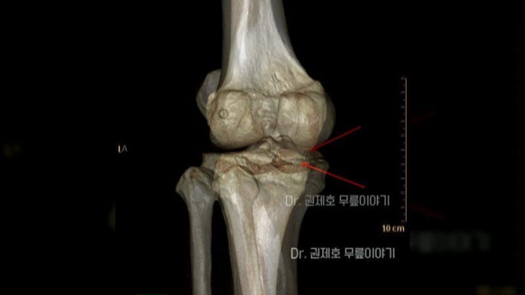  후방십자인대 견열골절 치료방법