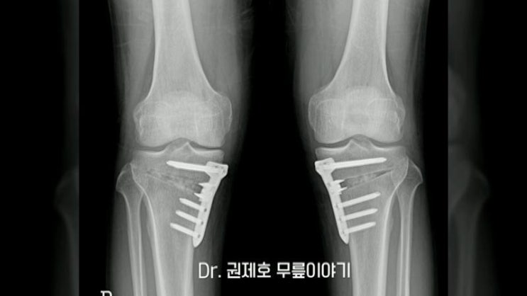  근위경골절골술 이란 무릎절골술 로 정교하게 교정