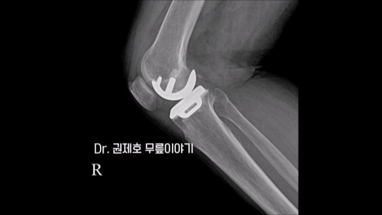  부분인공관절치환술 선택적으로 교체