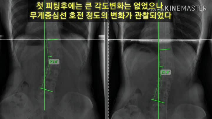 요추측만 5주만에 좋은결과~ : 네이버 블로그