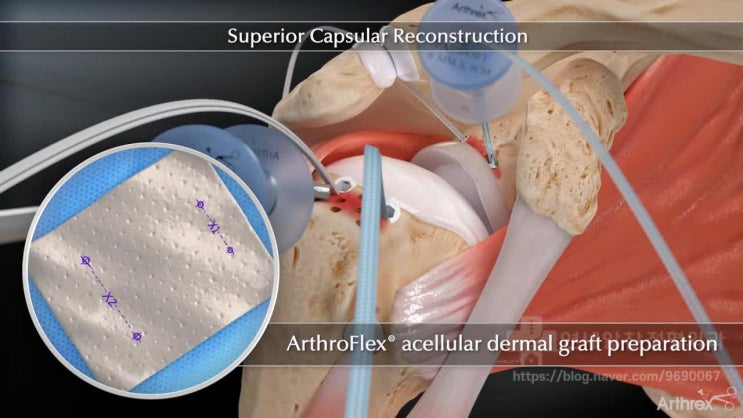 회전근개 재파열, 회전근개 재수술, 상부관절낭재건술