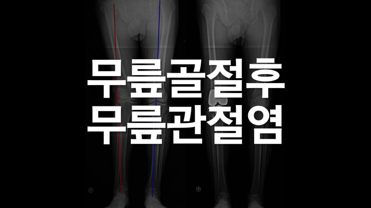  무릎 골절 후 관절염 by 권제호무릎수술일기