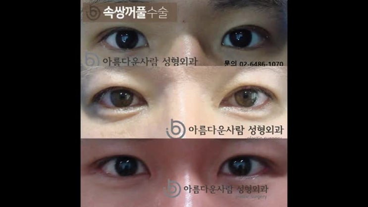 속쌍 쌍수 하는 것이 좋다는 분들께 : 네이버 블로그